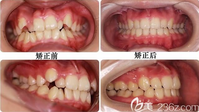 關于成人牙齒正畸價格的深度探討與解析