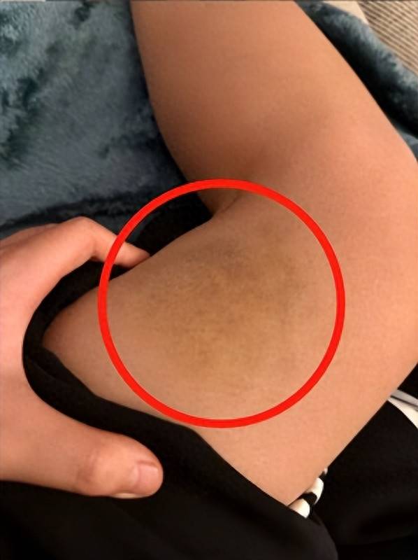 最新肺炎淤青智能監(jiān)測科技產(chǎn)品介紹,引領健康新紀元